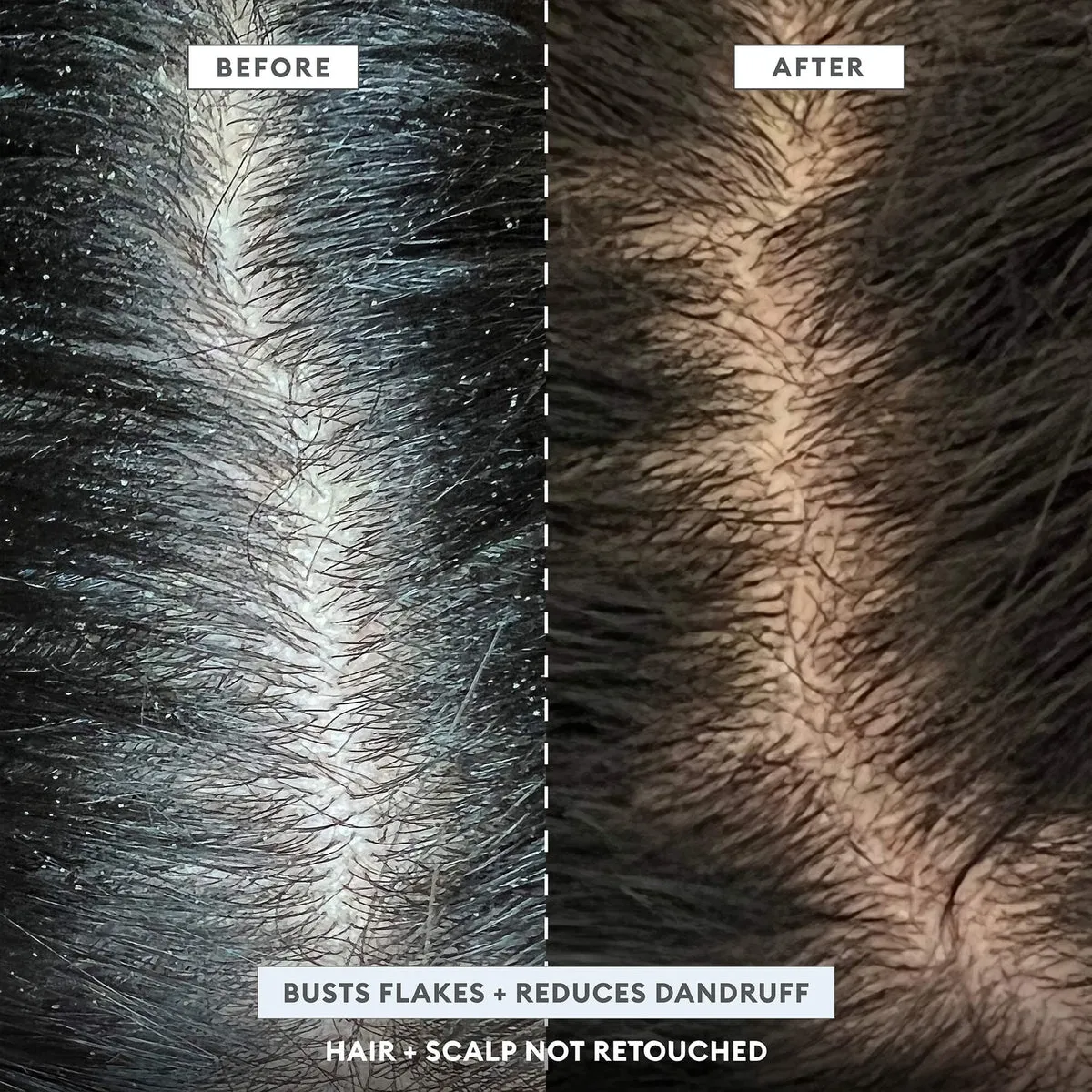 MegaStrength  Dandruff Relief Shampoo Charcoal   AHA/BHA